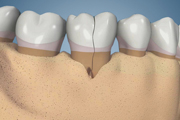 Cracked Tooth Molar Bone Loss